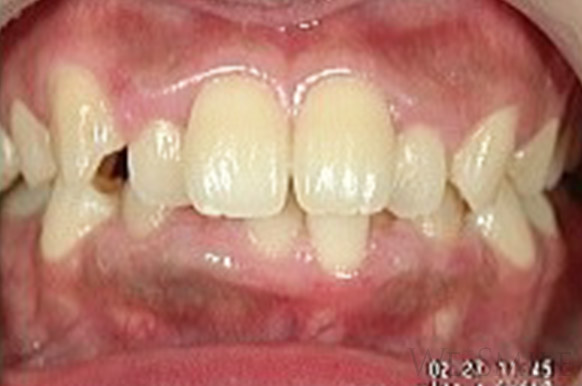 before